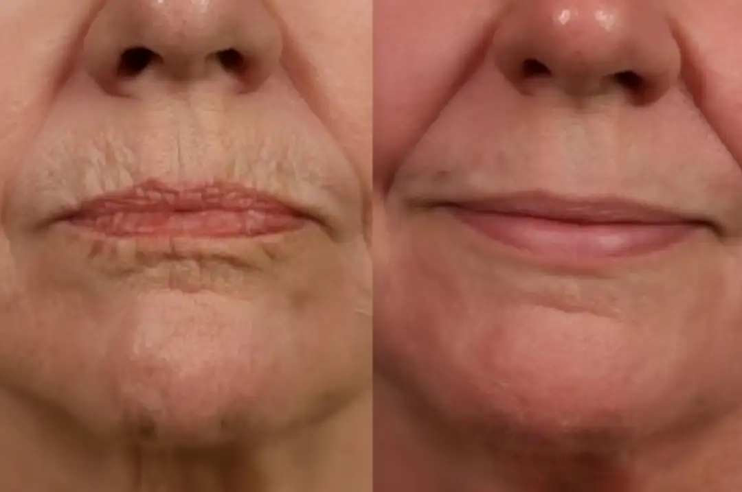peeling-antes-e-depois7