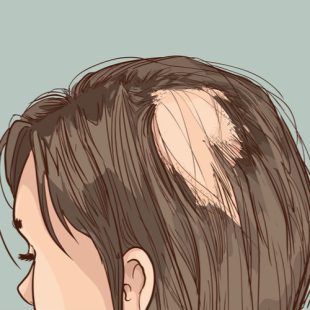 alopecia-cabeca.jpeg